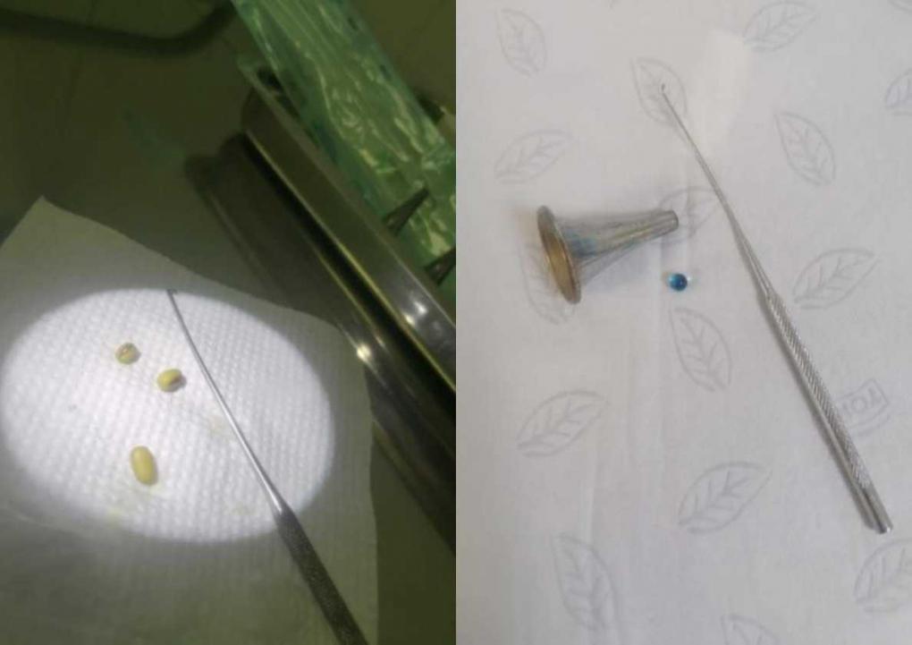 Не только детская проблема: оториноларинголог об извлечении инородных тел