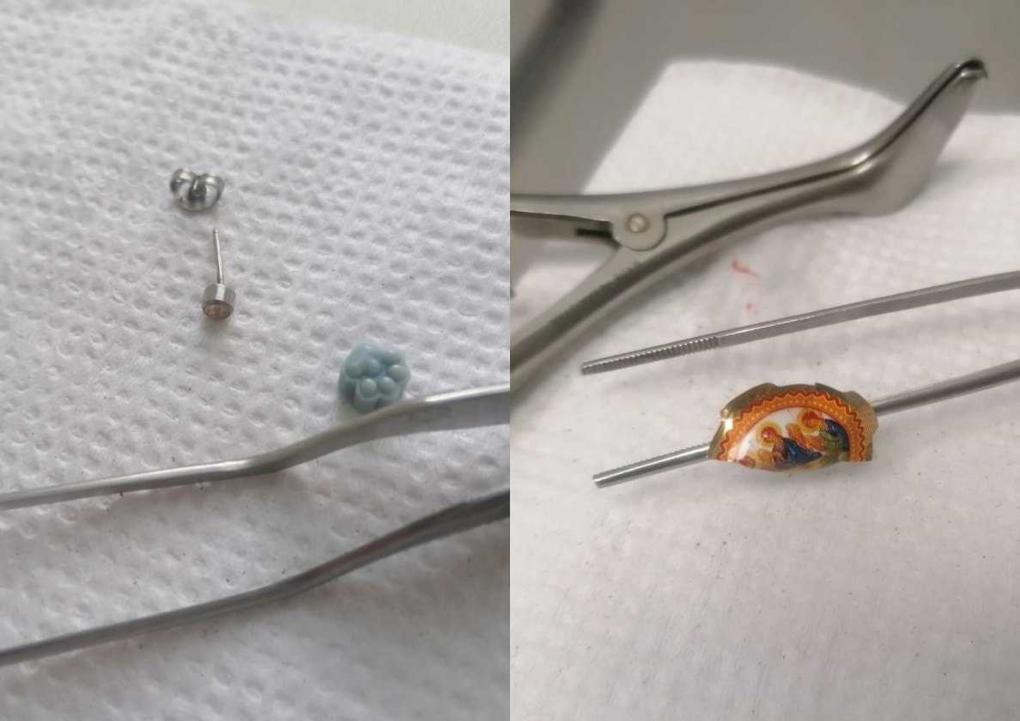 Не только детская проблема: оториноларинголог об извлечении инородных тел