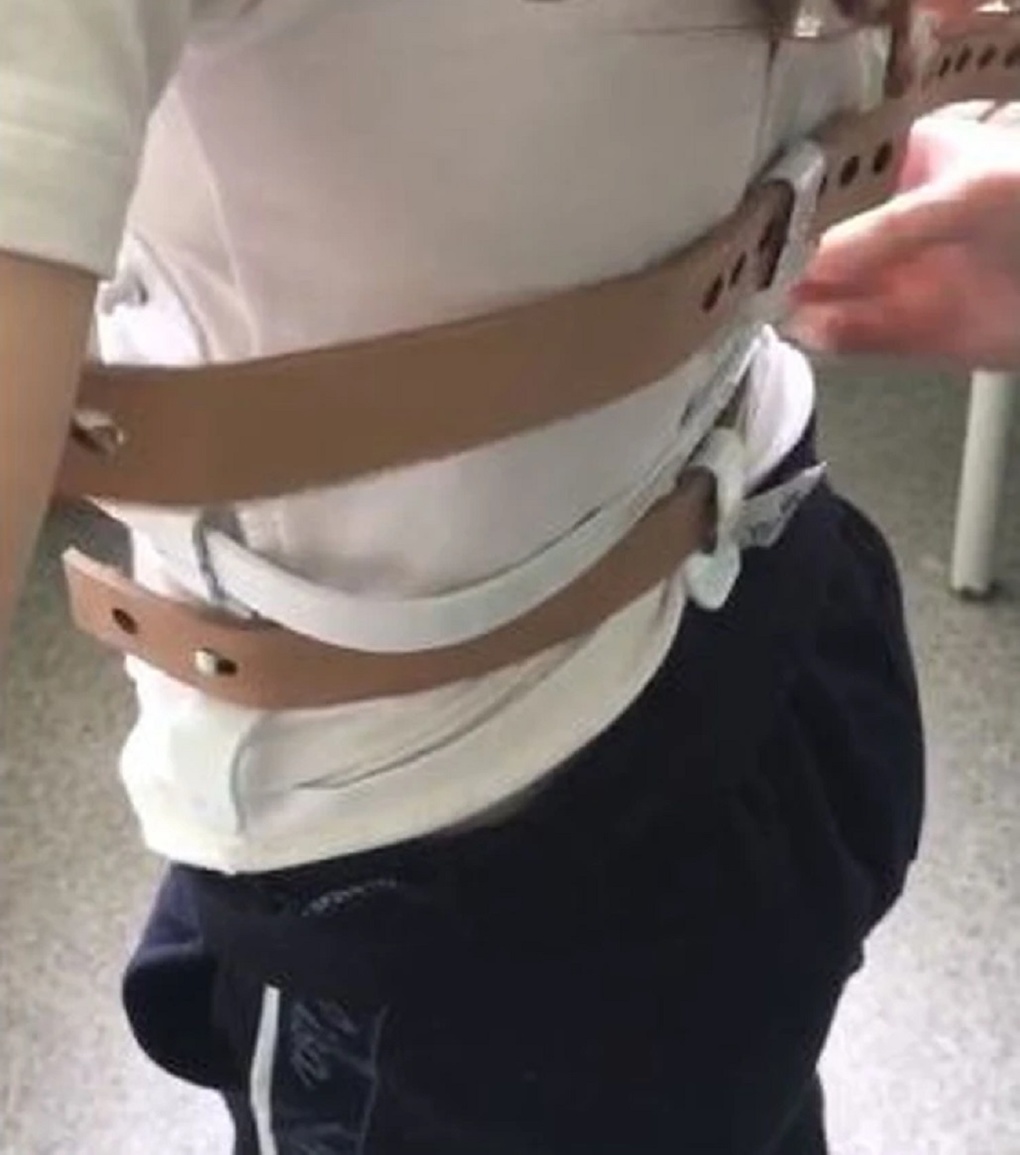 «Ты — кривоспинка»: новосибирскую школьницу затравили после перелома позвоночника на горке