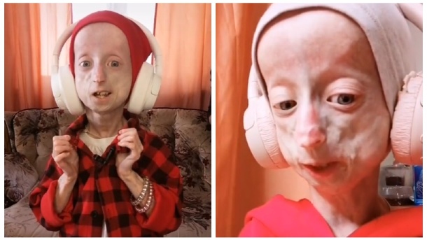 Выглядит сильно старше своих лет: девочка с редким заболеванием из Новосибирска стала звездой TikTok