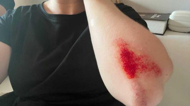 Мальчик-рыбка с редким заболеванием пошел в первый класс в Новосибирске