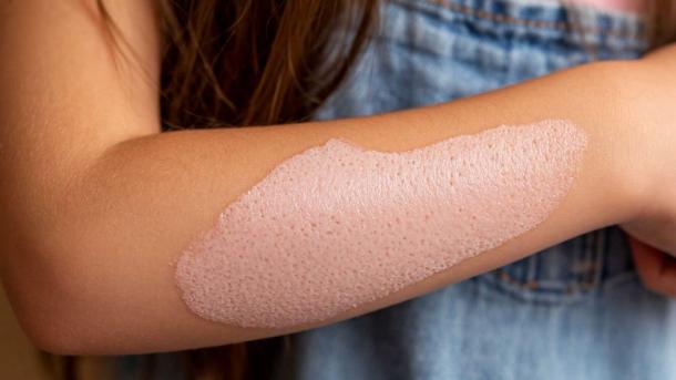 Аллерголог объяснила, почему у петербургской школьницы начала слезать кожа от вейпа