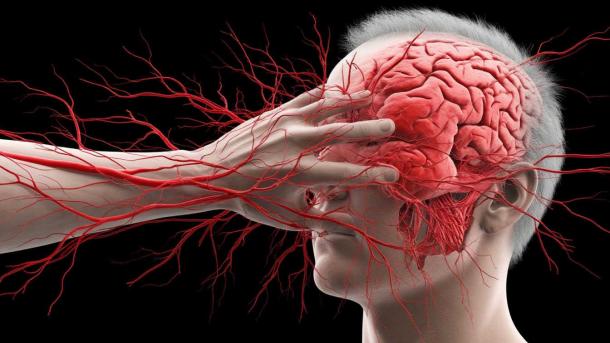 Врач-невролог: простой тест «УЗП» поможет распознать инсульт за минуту