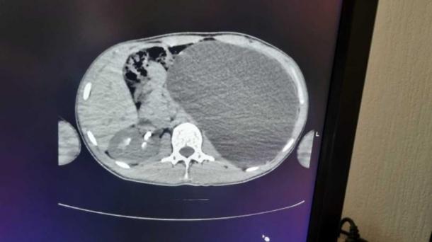 «Бомба замедленного действия»: у 17-летнего новосибирца почка раздулась до пятилитровой бутылки