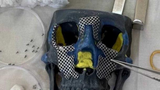 Врачи собрали лицо из 30 осколков: история Юлии из Набережных Челнов