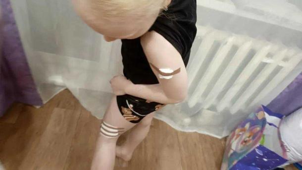 Маленькая омичка, пострадавшая от приставов, стала жертвой собаки