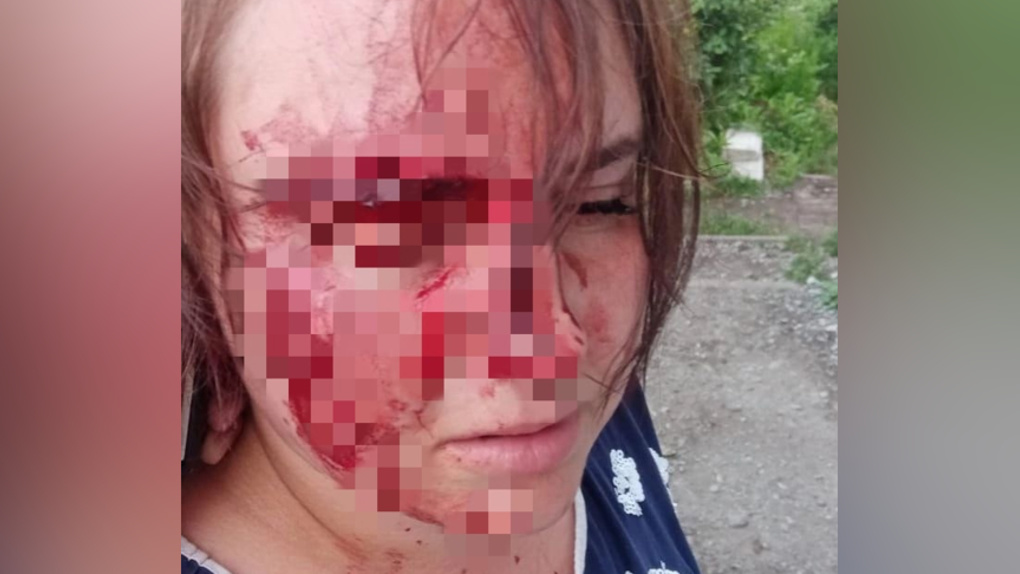 Лицо в крови: сосед зверски избил жительницу Новосибирска из-за машины