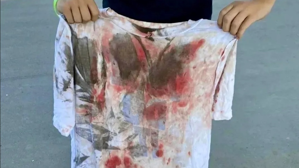 Мальчик весь в крови: школьник на самокате получил травмы в экстрим-парке