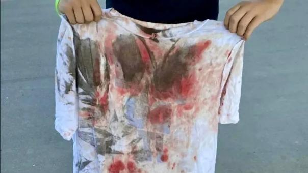 Мальчик весь в крови: школьник на самокате получил травмы в экстрим-парке