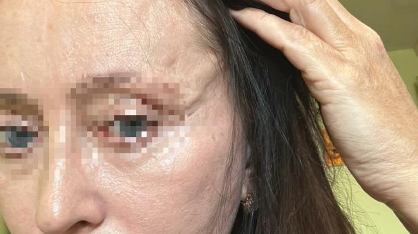 Пациентка рассказала о кошмарном опыте фейслифтинга в Новосибирске