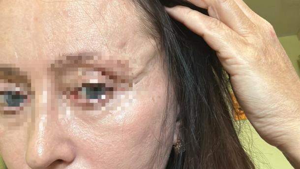 Пациентка рассказала о кошмарном опыте фейслифтинга в Новосибирске