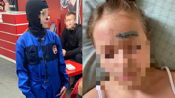 Лицо в крови, видно кость: рваную рану лба получила 9-летняя девочка на картинге в Новосибирске. ФОТО