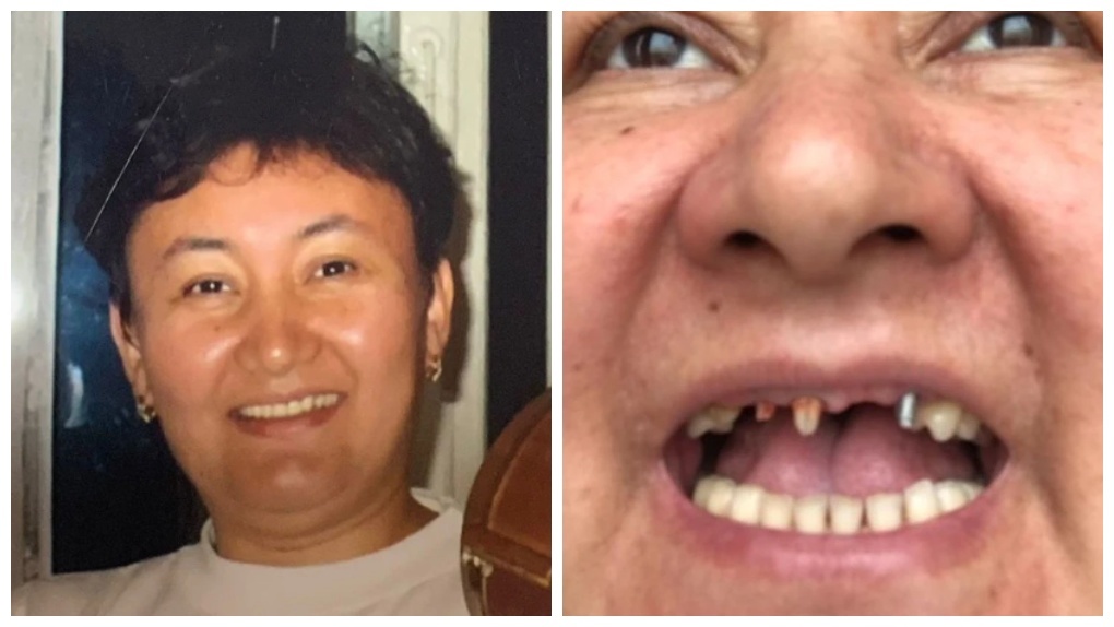 «Осталась без верхних зубов»: жительница Новосибирска отсудила у стоматологии 240 тысяч рублей