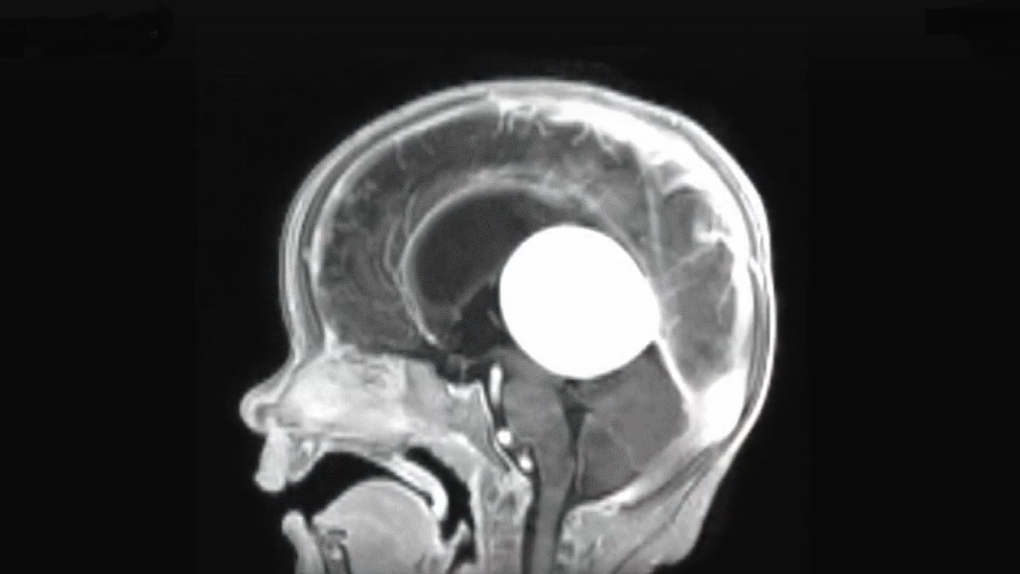 Раздулся шар в мозге: новосибирские хирурги спасли 7-месячного ребёнка от гибели