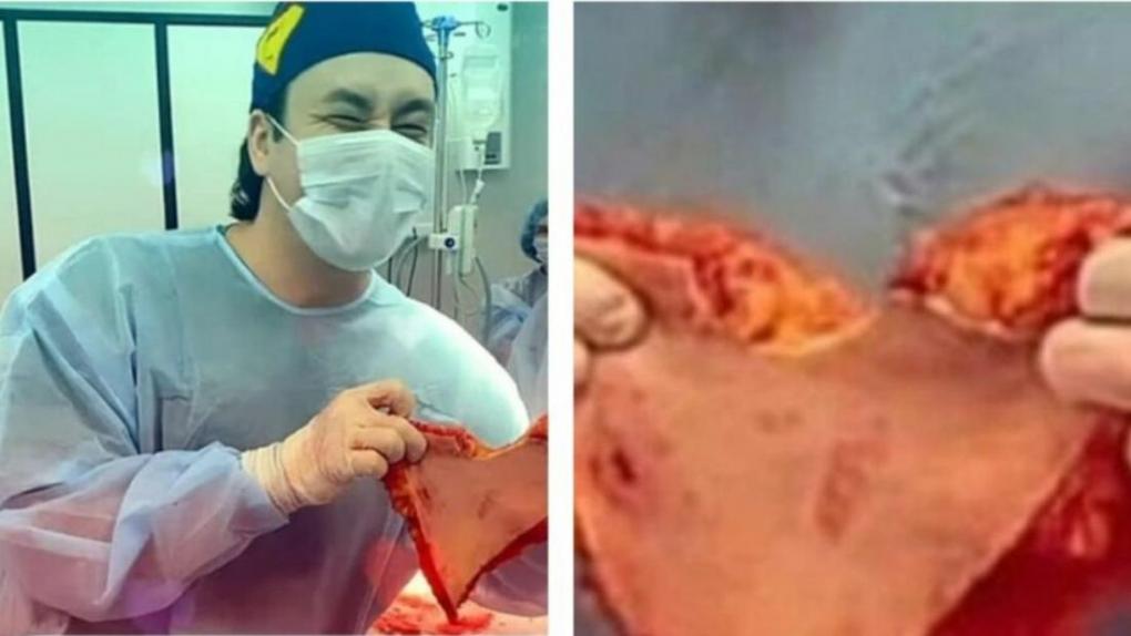 Новосибирского хирурга, вырезающего «сердечки» из человеческой кожи, проверит МВД