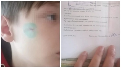Деформировал челюсть: 12-летнего мальчика жестоко избил мужчина в камуфляжном костюме