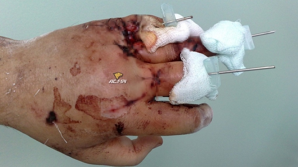 Новосибирец жестоко избил водителя сапёрной лопатой: шокирующие фото