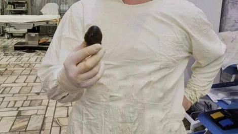 Омские хирурги вытащили из тела женщины огромный камень