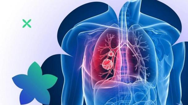 Слабость и кашель: омские врачи назвали главные признаки рака лёгкого