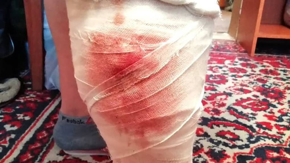 Собака вырвала кусок мяса из ноги беременной женщины под Новосибирском