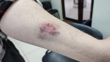 Вцепился в вену: новосибирец искусал таксиста и обвинил его в похищении