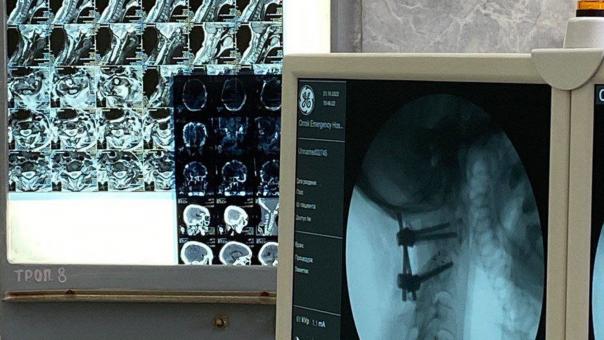 Омские хирурги провели сложнейшую операцию на позвоночнике