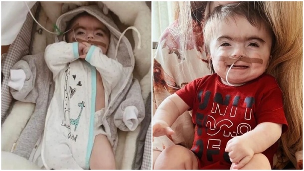 Жительница Новосибирска родила мальчика с лицом эльфа. ФОТО